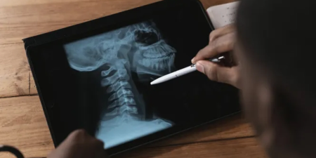 Спондилоартоз