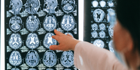 Атрофия головного мозга